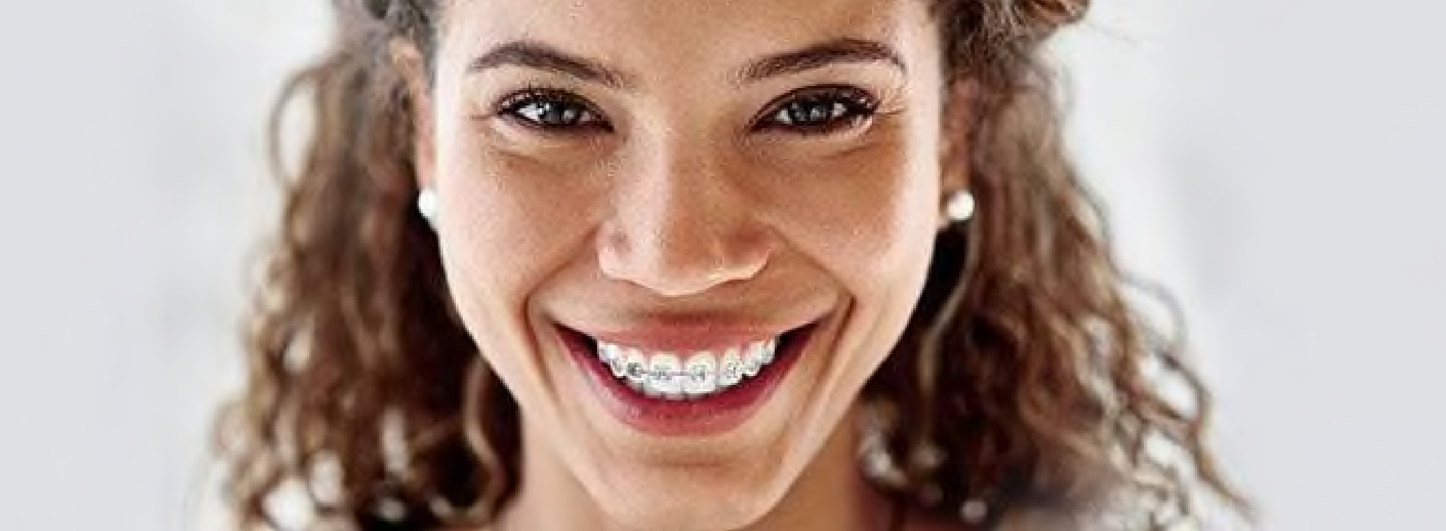 Can I Use Whitestrips if I Have Braces or a Retainer?